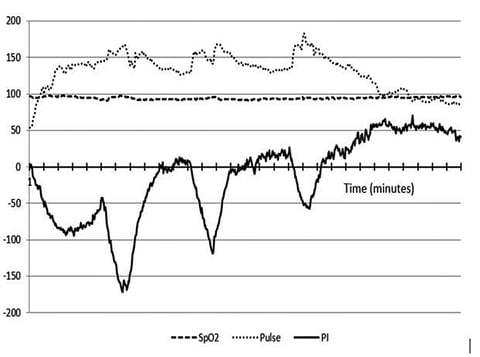 Sensors Insights 3 2017-09-08 Fig5 PI Trend during a 30 minute, 3-interval stationary bicycle exercise.